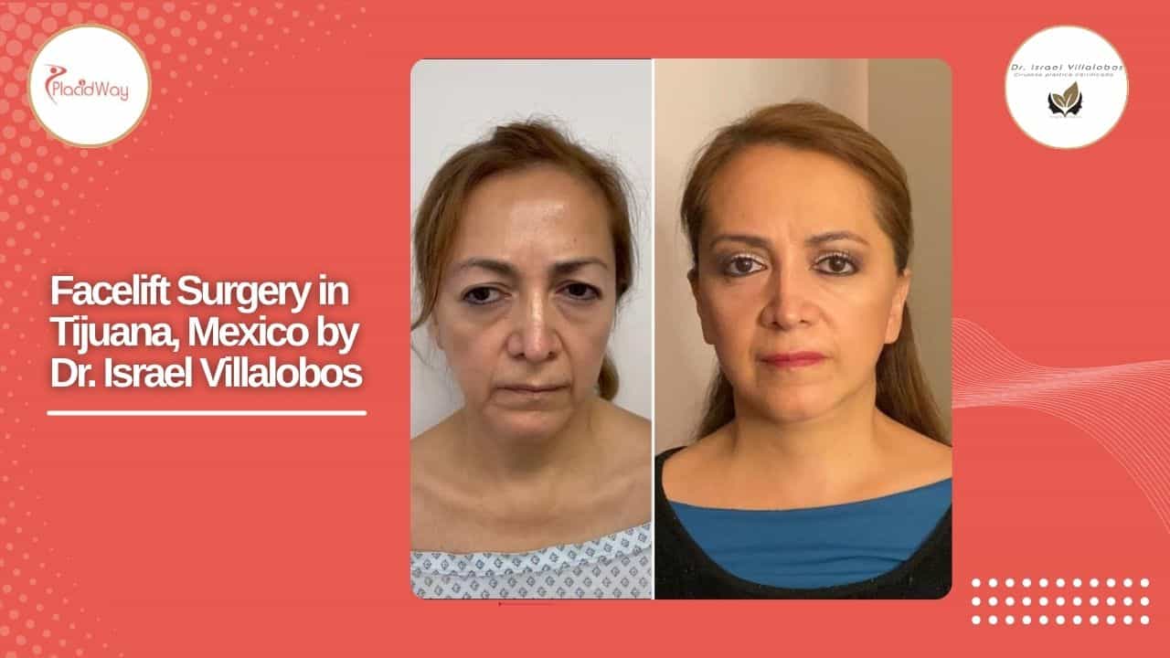 Facelift Before and After Result 10