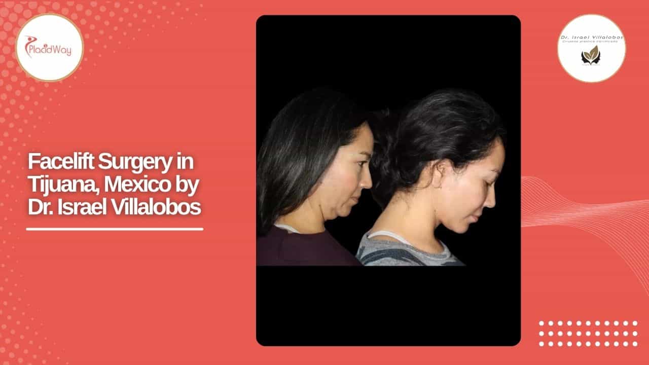 Facelift Before and After Result 11
