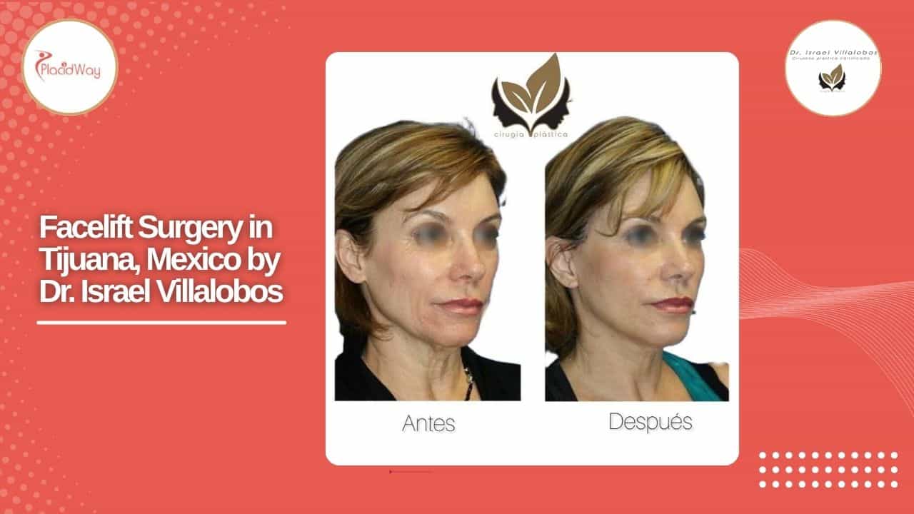 Facelift Before and After Result 12