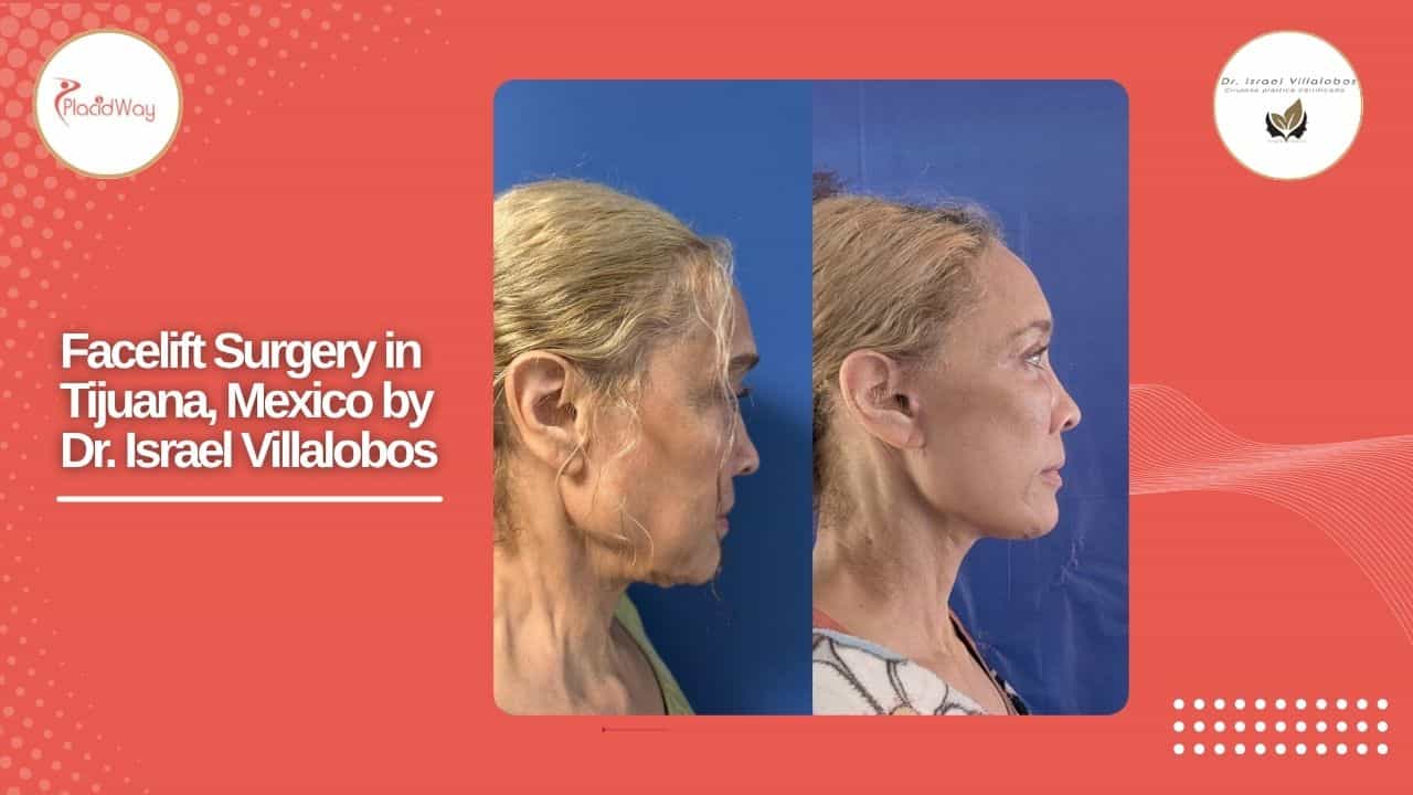 Facelift Before and After Result 13