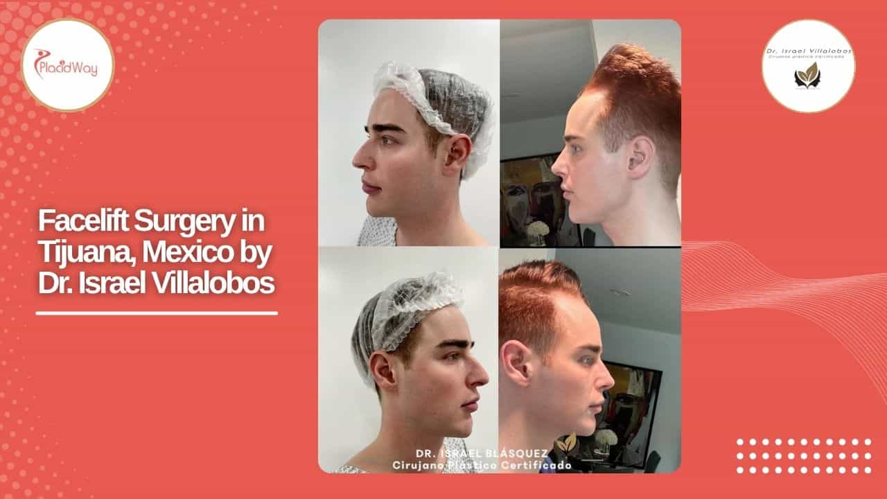 Facelift Before and After Result 15