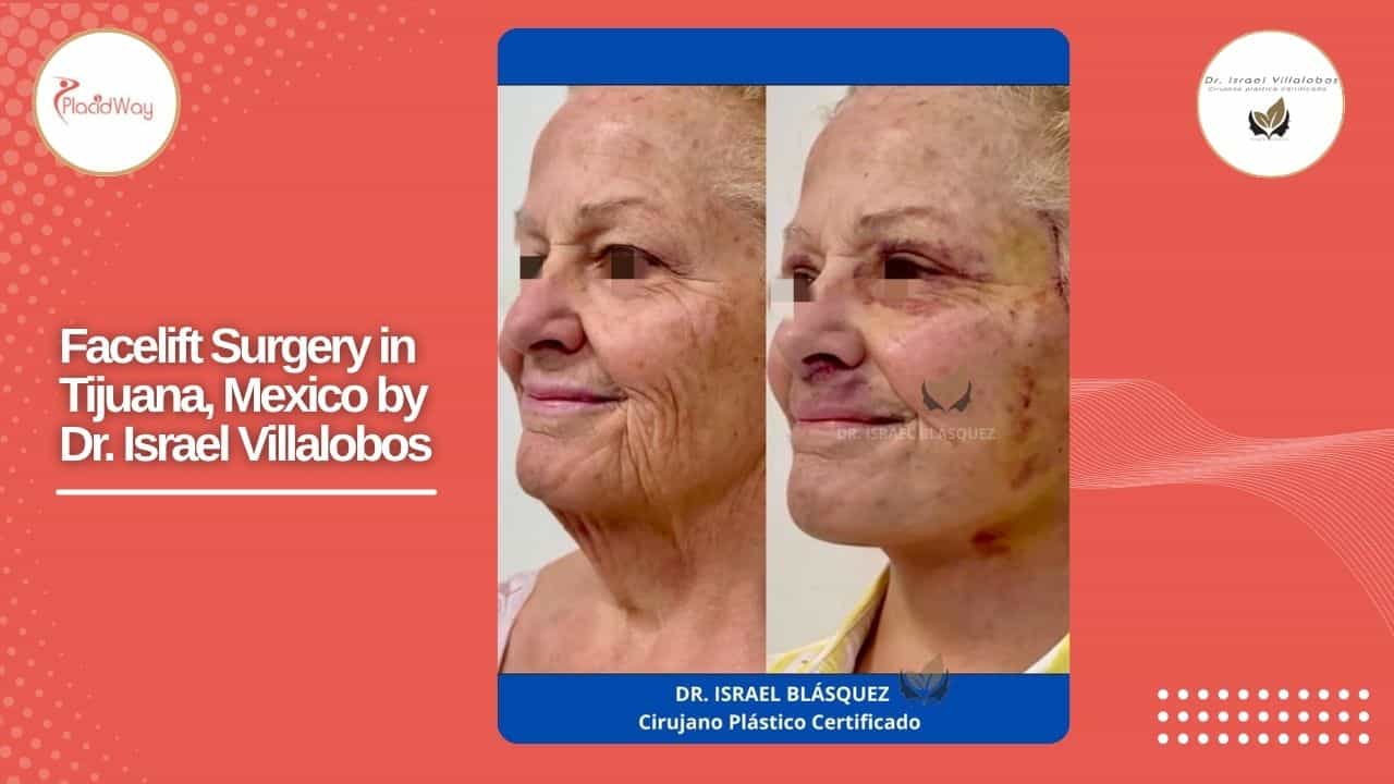 Facelift Before and After Result 16