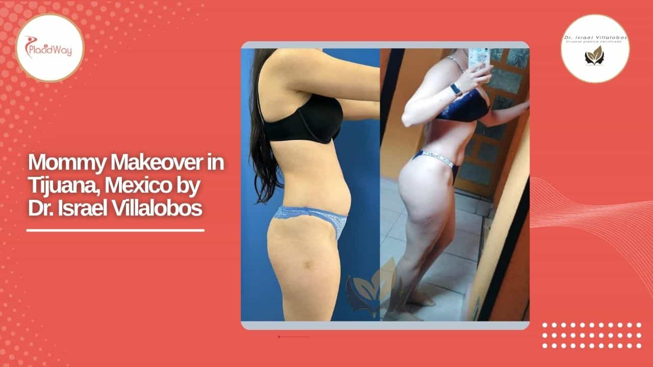 Mommy Makeover Before and After Result 2