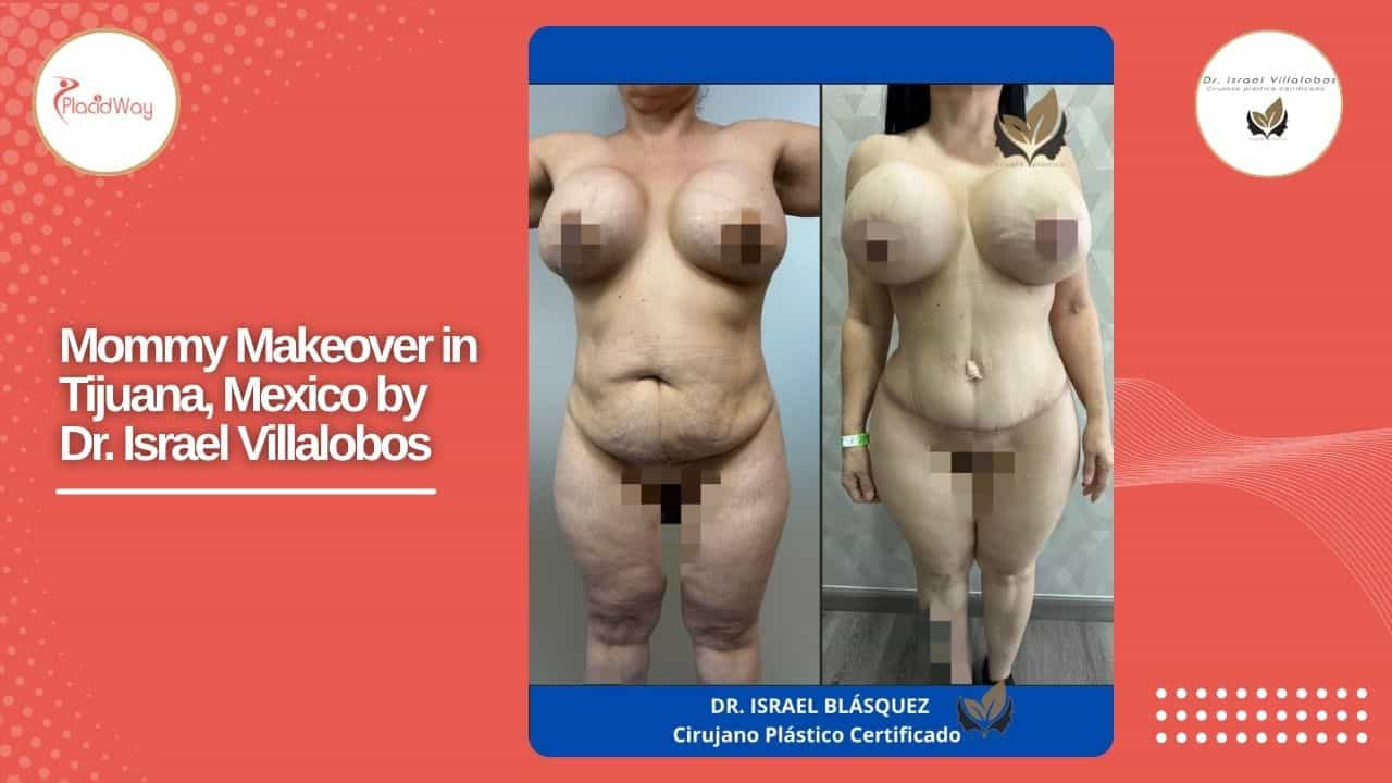 Mommy Makeover Before and After Result 3
