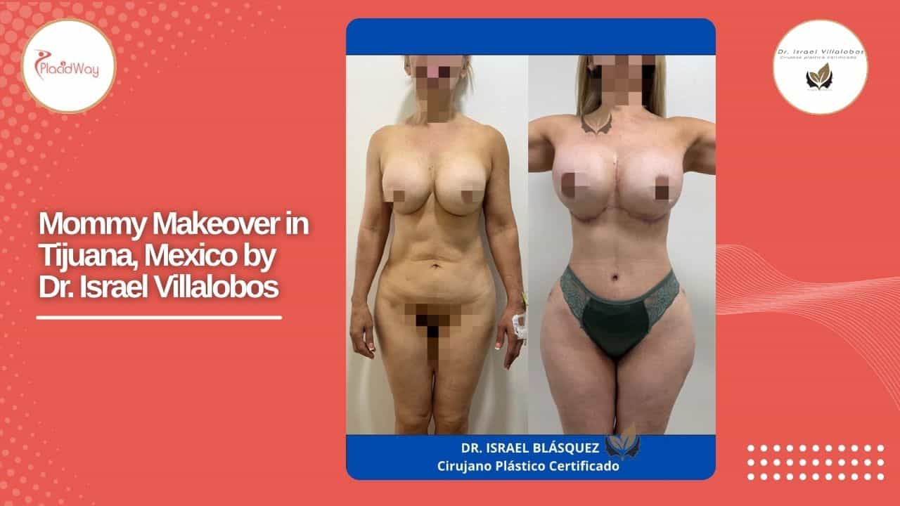 Mommy Makeover Before and After Result 5