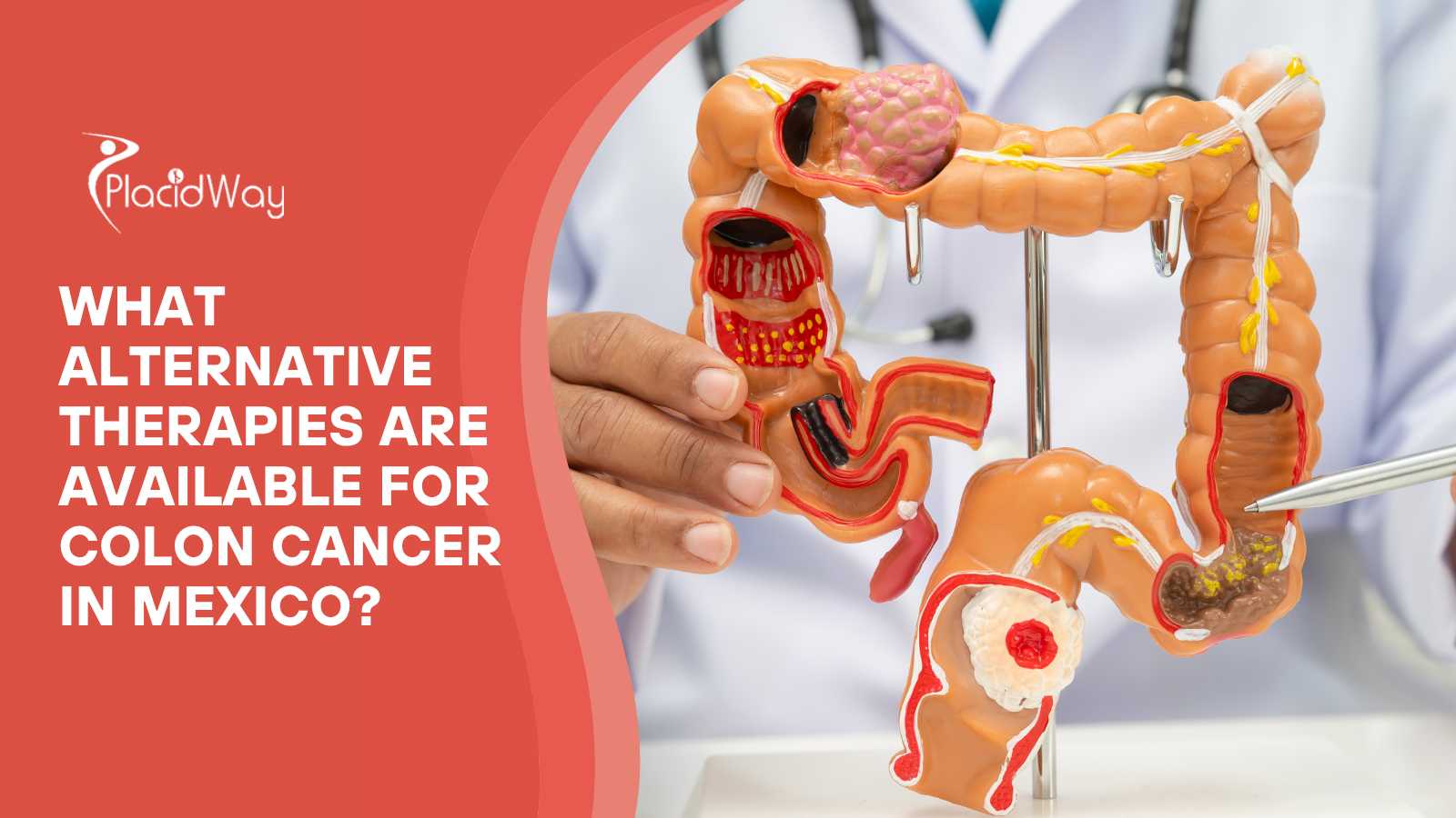 What alternative therapies are available for colon cancer in Mexico?