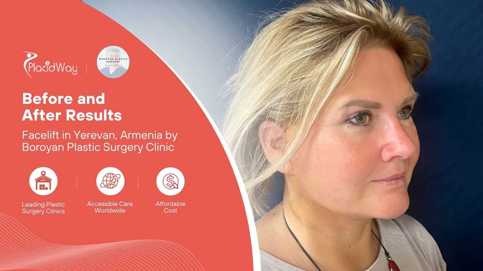 Facelift in Yerevan Armenia at Boroyan Plastic Surgery Clinic