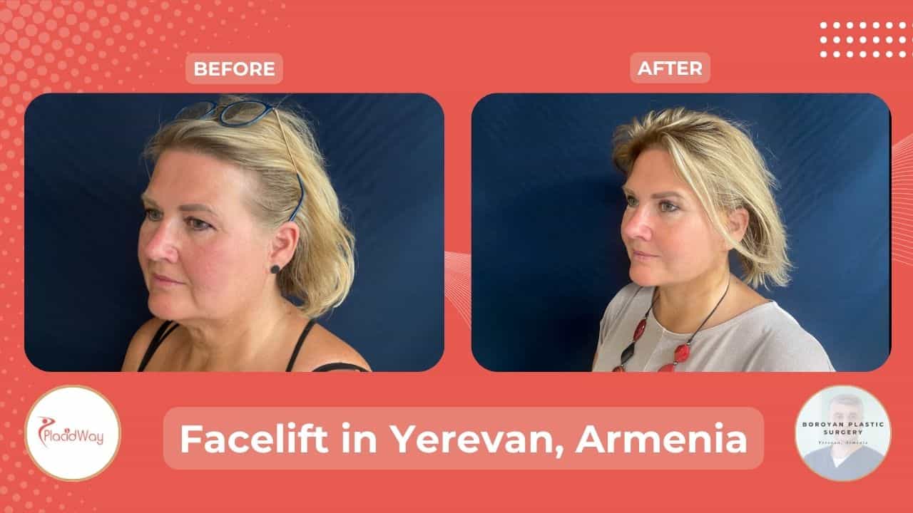 Face Lift Surgery in Yerevan Armenia