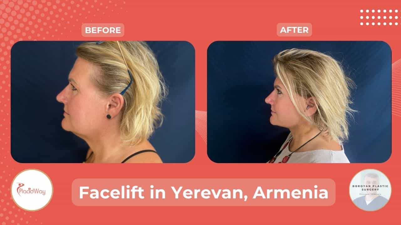 Rhytidectomy in Yerevan Armenia