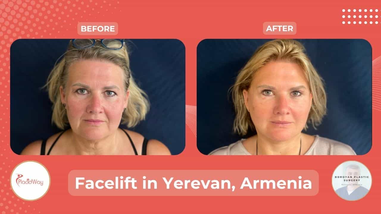 Cosmetic Facial Surgery in Yerevan Armenia