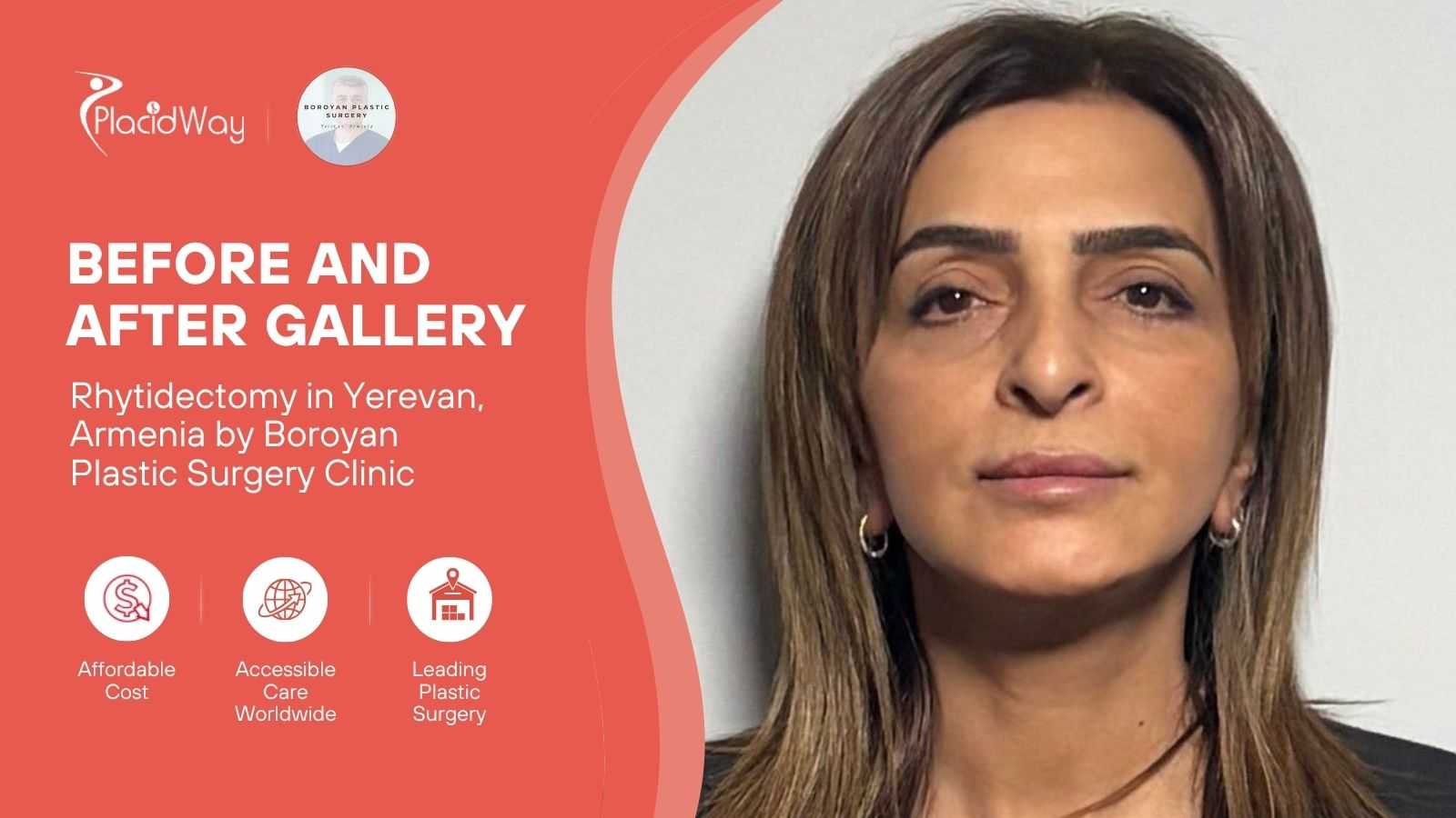 Facelift Surgery in Yerevan Armenia