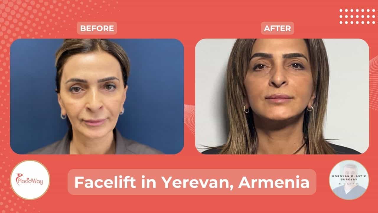 Rhytidectomy in Yerevan Armenia