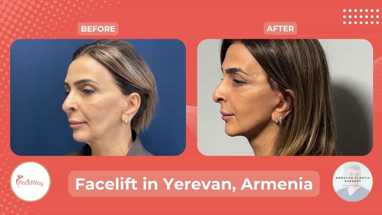 Facelift Surgery in Armenia