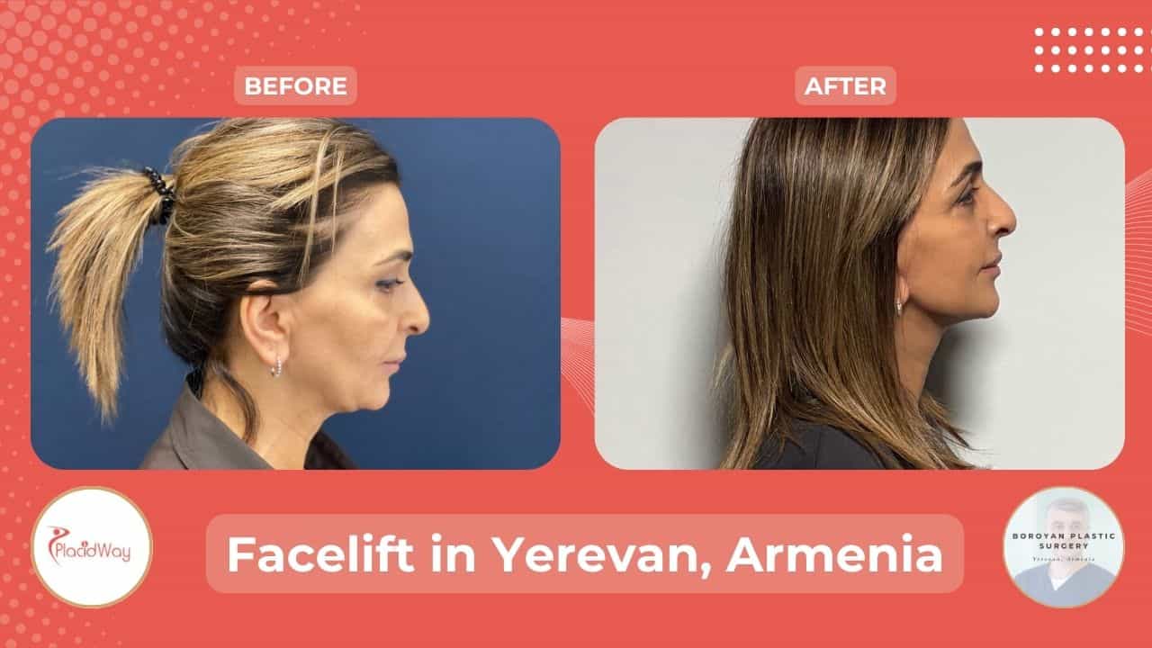 Face Lift Surgery in Armenia