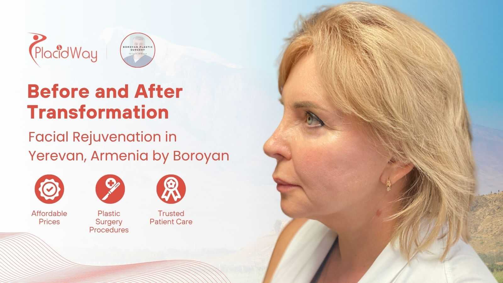 Facial Rejuvenation in Yerevan Armenia at Boroyan Plastic Surgery Clinic