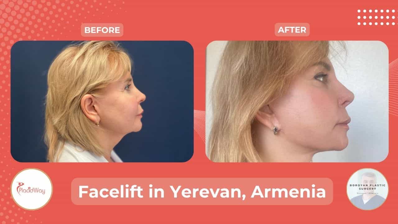Facelift Surgery in Yerevan Armenia