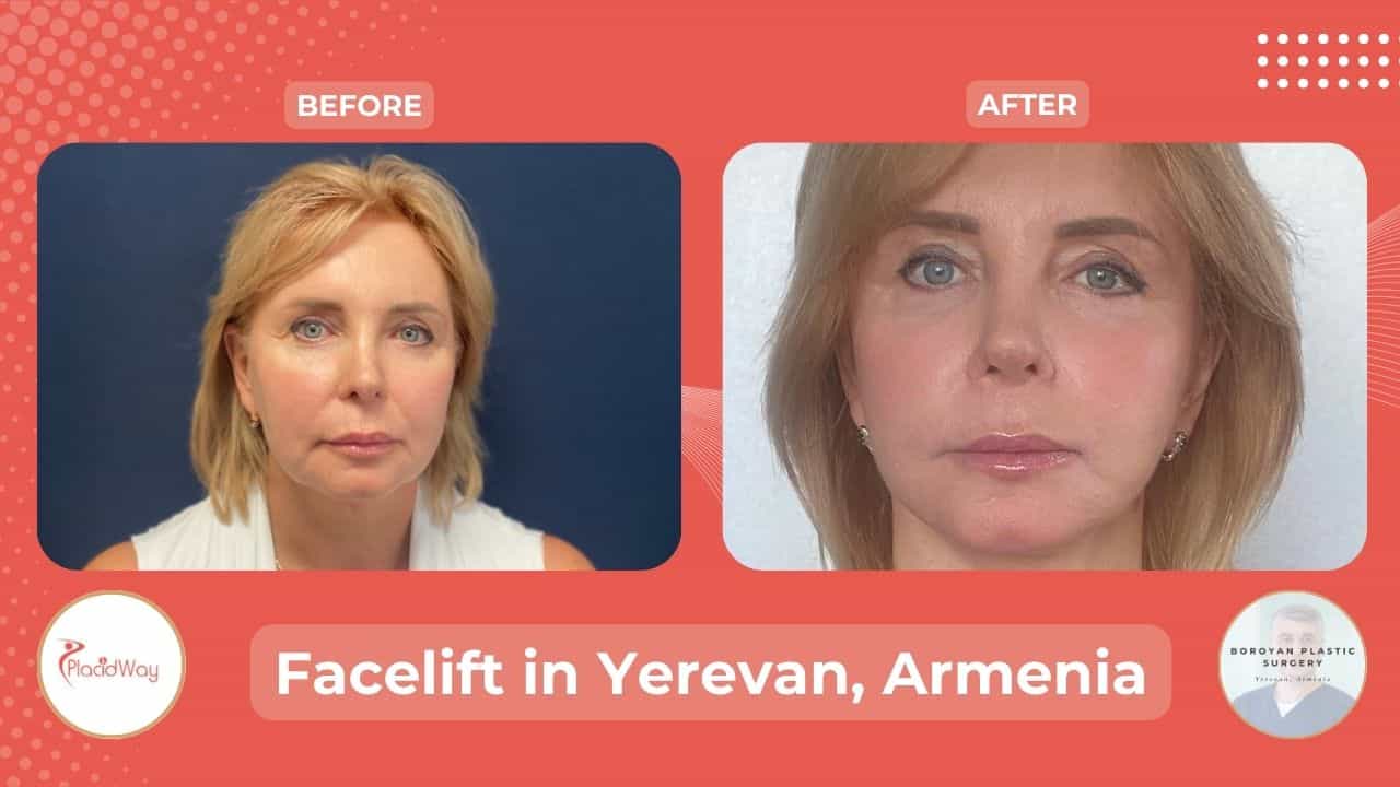 Face Lift Surgery in Armenia