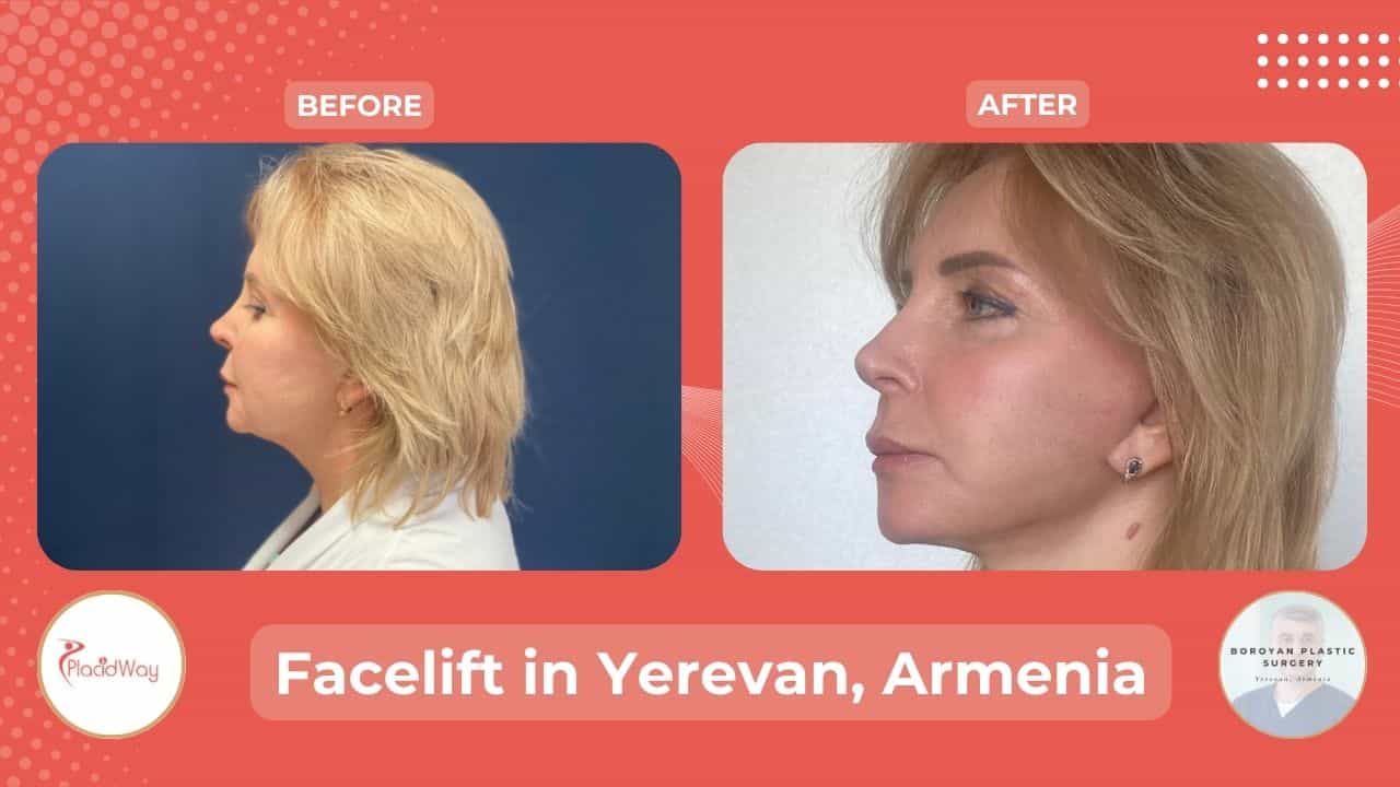 Facial Rejuvenation in Yerevan, Armenia