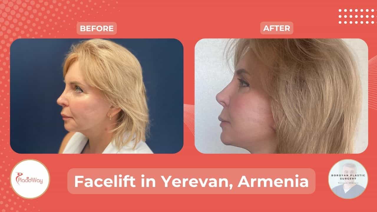Cosmetic Facelift in Yerevan, Armenia
