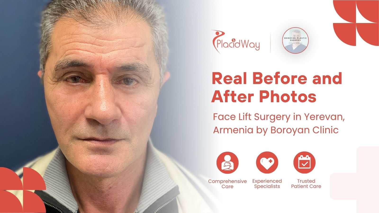 Facelift Surgery in Yerevan Armenia at Boroyan Plastic Surgery Clinic