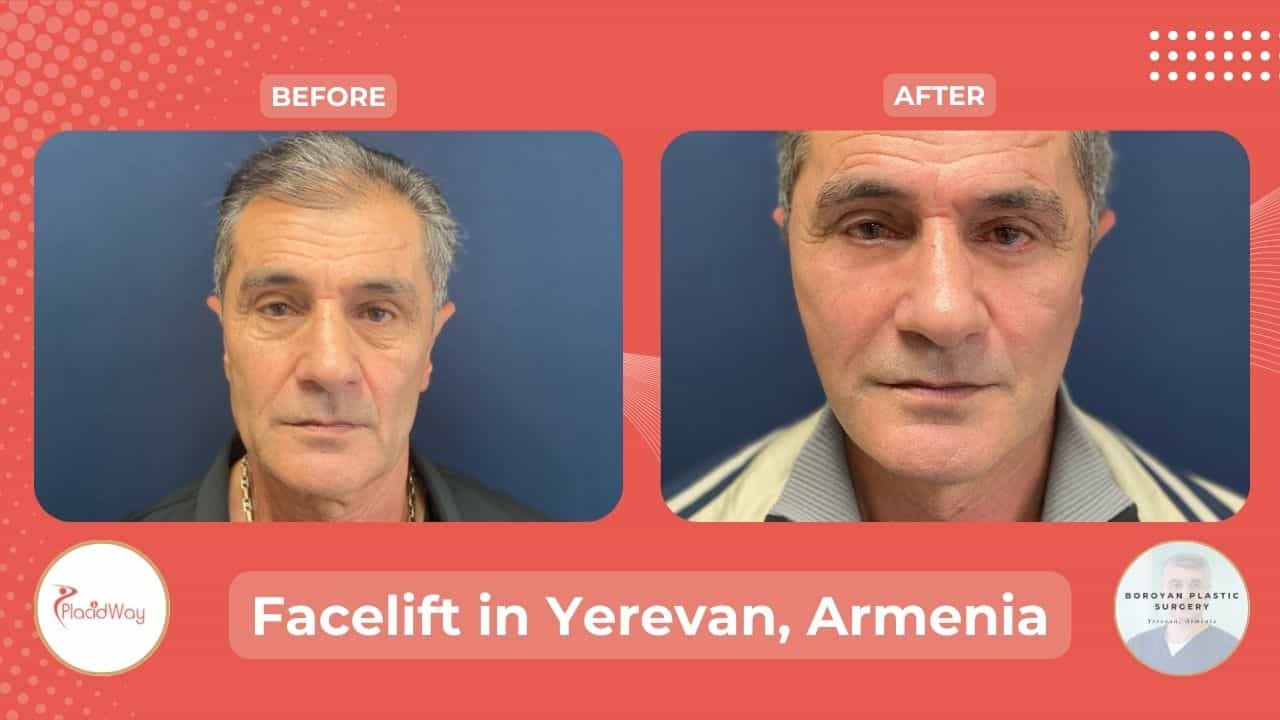 Facelift Surgery in Yerevan Armenia