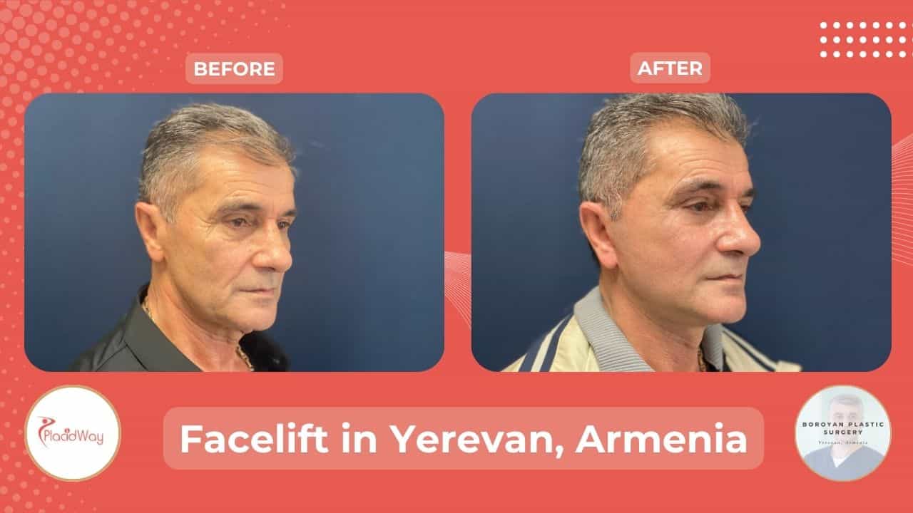 Face Lift Surgery in Yerevan Armenia