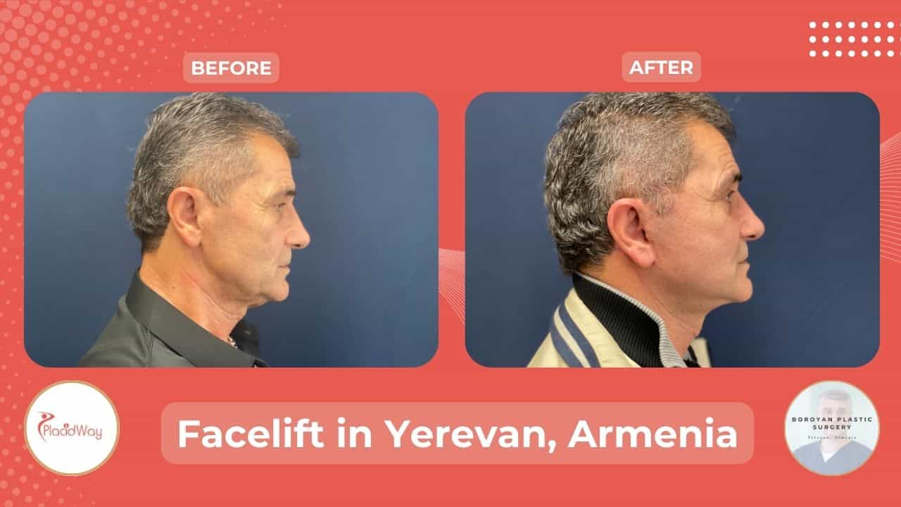 Face Lift Surgery in Yerevan Armenia Before After