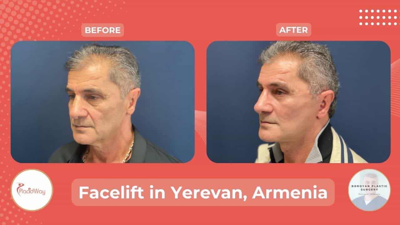 Before After Image for Face Lift Surgery in Yerevan Armenia