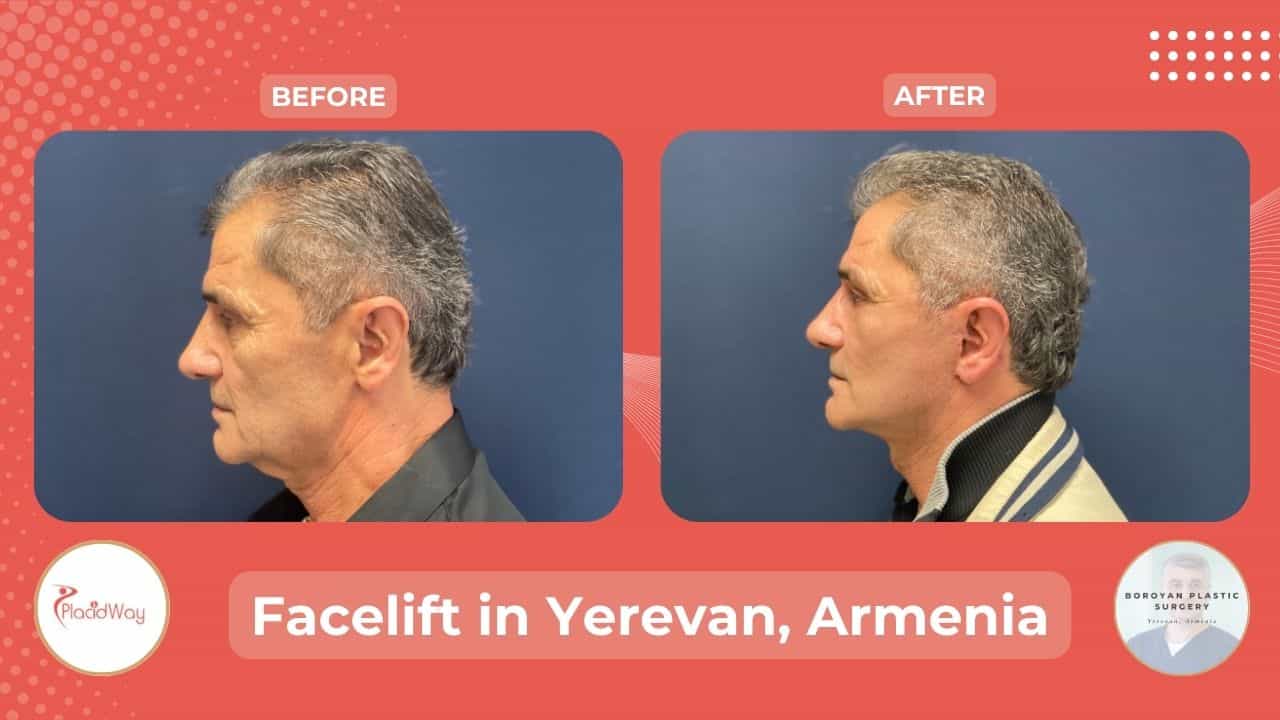Face Lift Surgery in Armenia