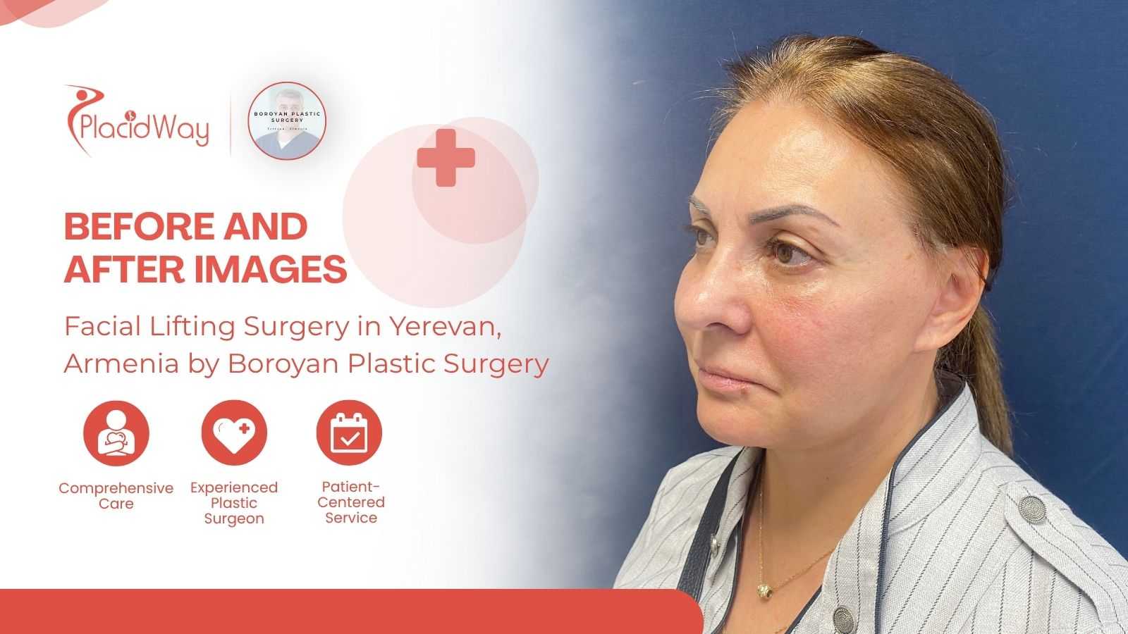 Facial Lifting Surgery in Yerevan, Armenia by Boroyan Plastic Surgery Clinic