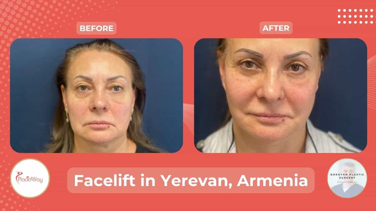 Facelift Surgery in Yerevan Armenia