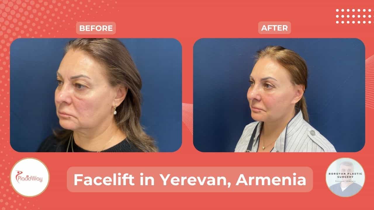 Face Lift Surgery in Yerevan Armenia