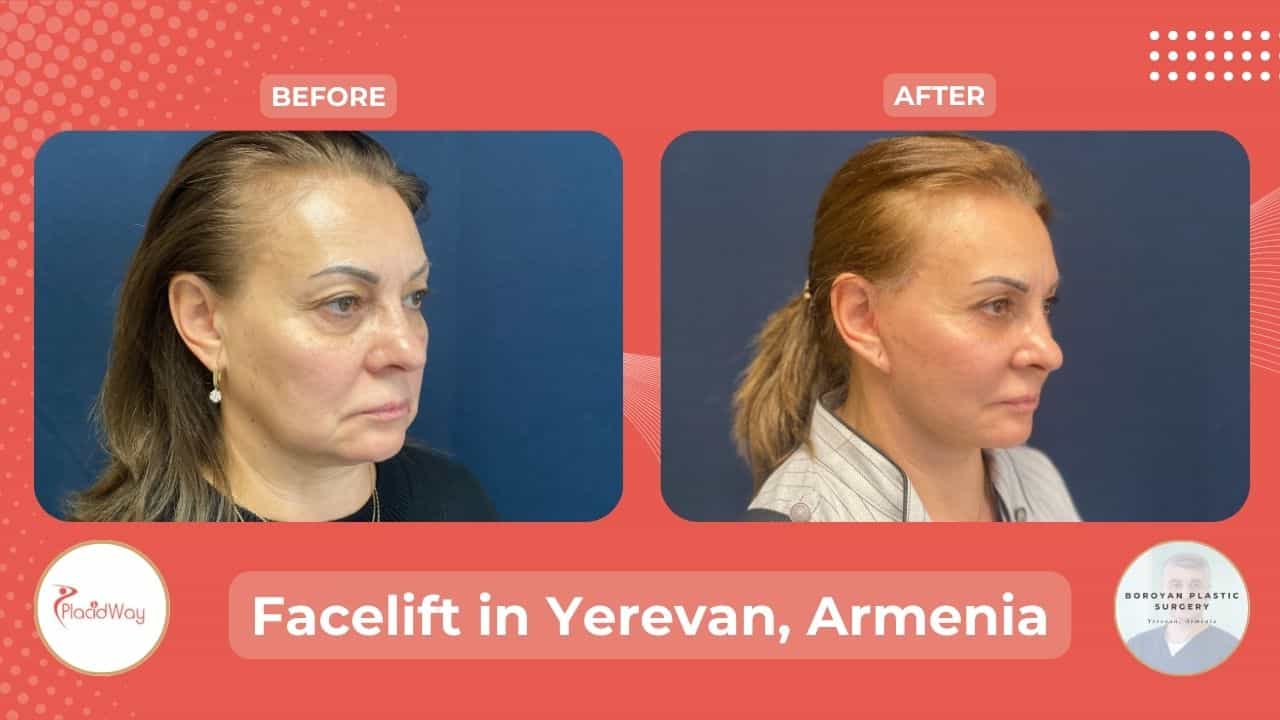 Facelift Surgery in Yerevan Armenia Before After