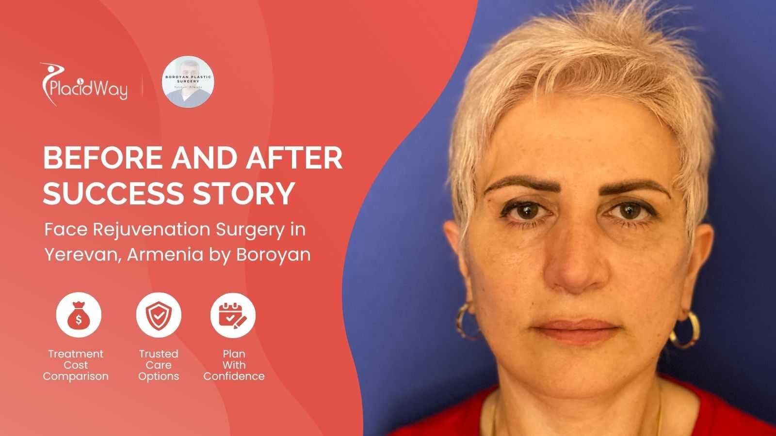 Facelift Surgery in Yerevan Armenia