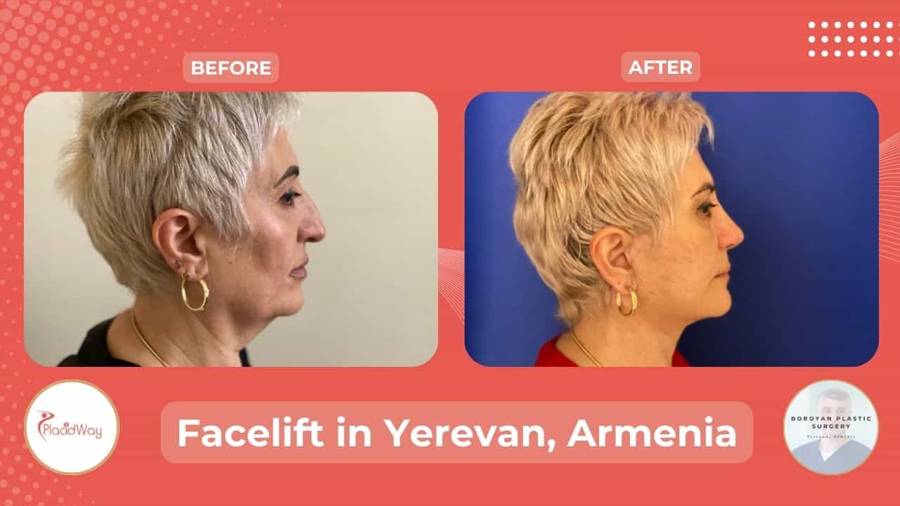 Facelift Surgery in Yerevan Armenia