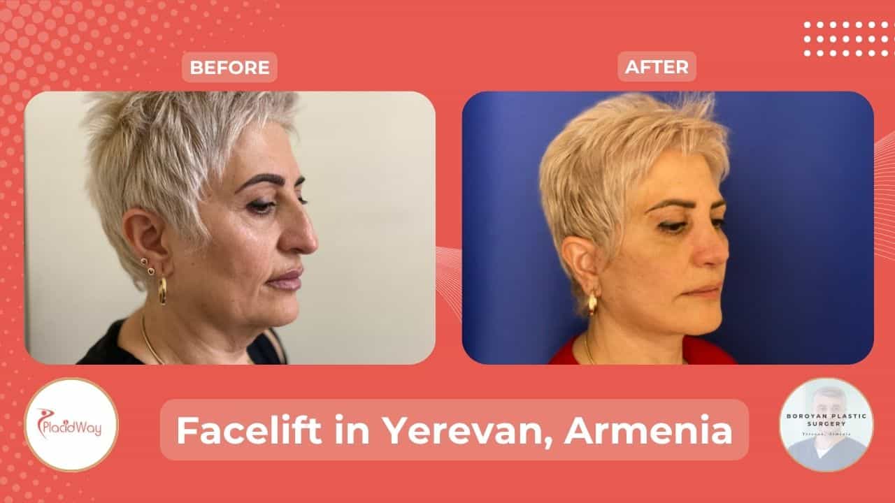 Facelift Surgery in Armenia