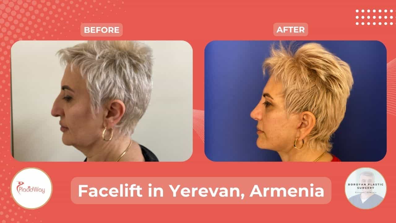 Rhytidectomy in Yerevan Armenia