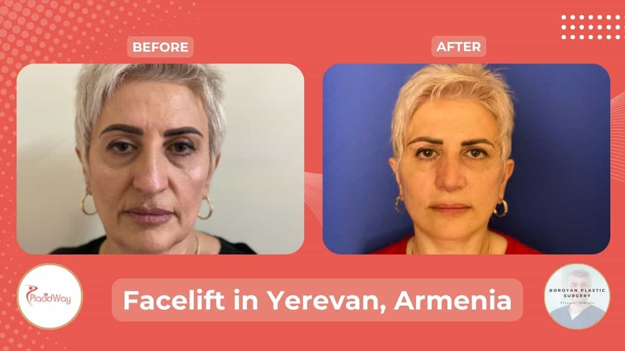 Facelift Surgery in Yerevan Armenia Before After