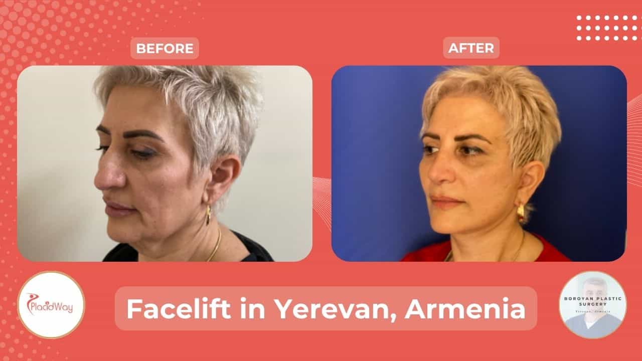 Facial Rejuvenation in Yerevan Armenia Before and After