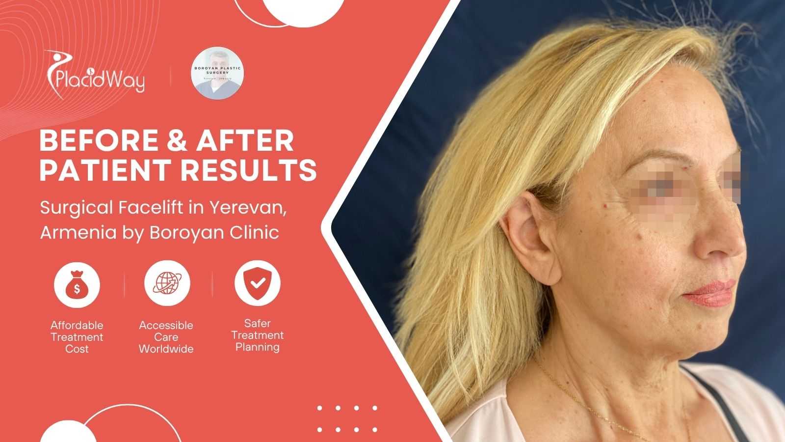 Facelift Surgery in Yerevan Armenia at Boroyan Plastic Surgery Clinic