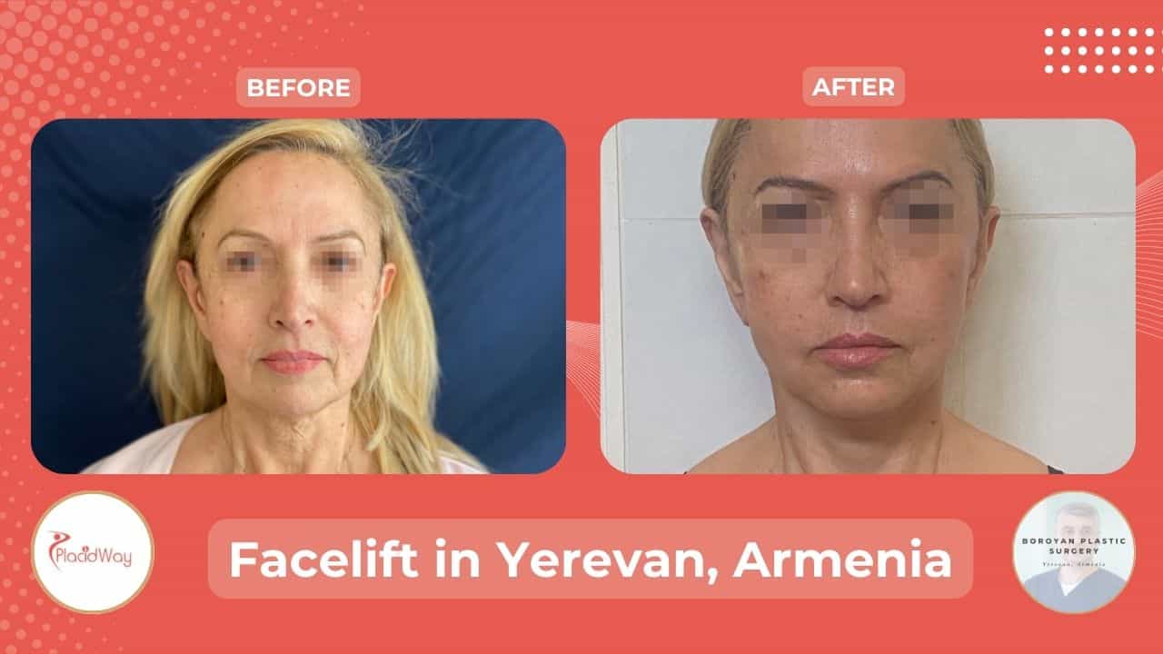 Surgical Face Lift in Yerevan Armenia