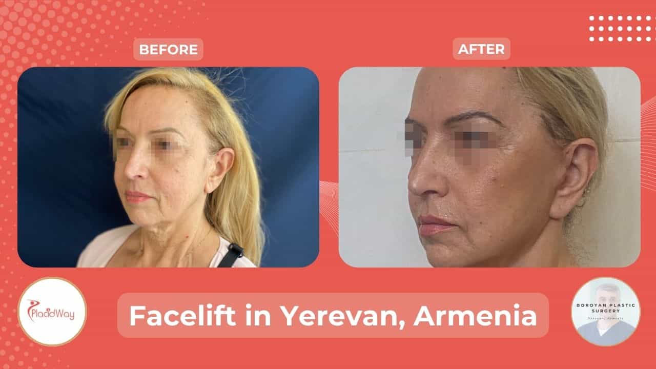 Face Lift Surgery in Yerevan Armenia