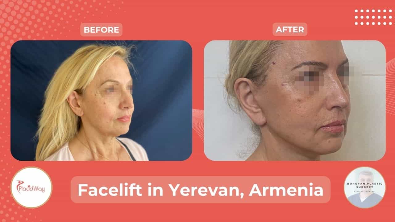 Rhytidectomy in Yerevan Armenia