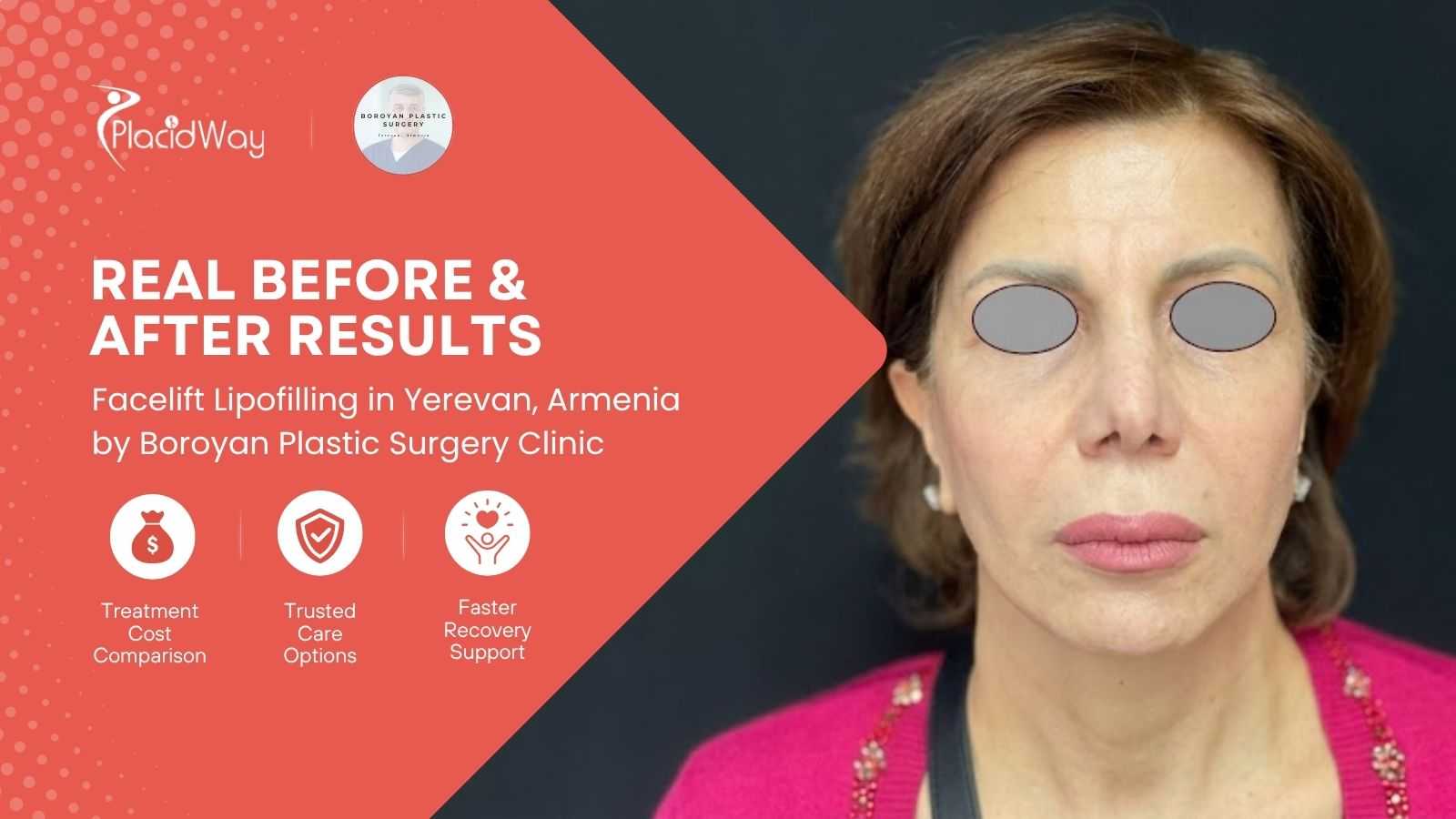 Facelift Lipofilling in Yerevan Armenia by Boroyan Plastic Surgery Clinic