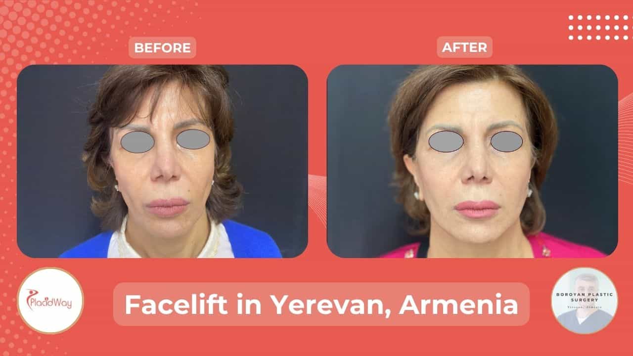 Facelift Lipofilling in Yerevan Armenia