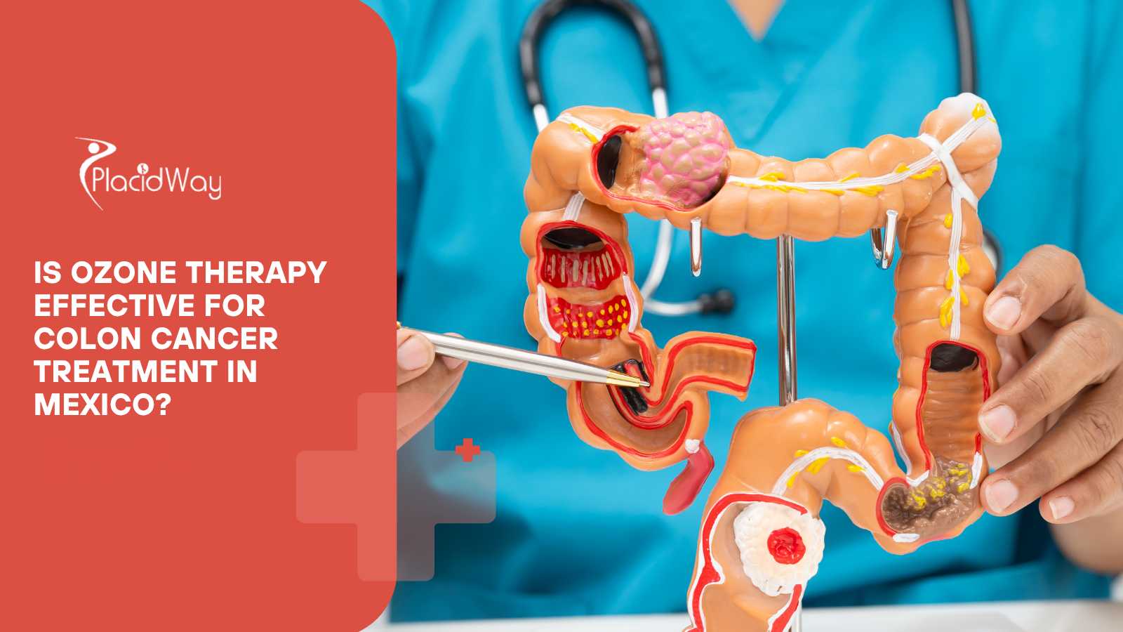 Is Ozone Therapy Effective for Colon Cancer Treatment in Mexico?