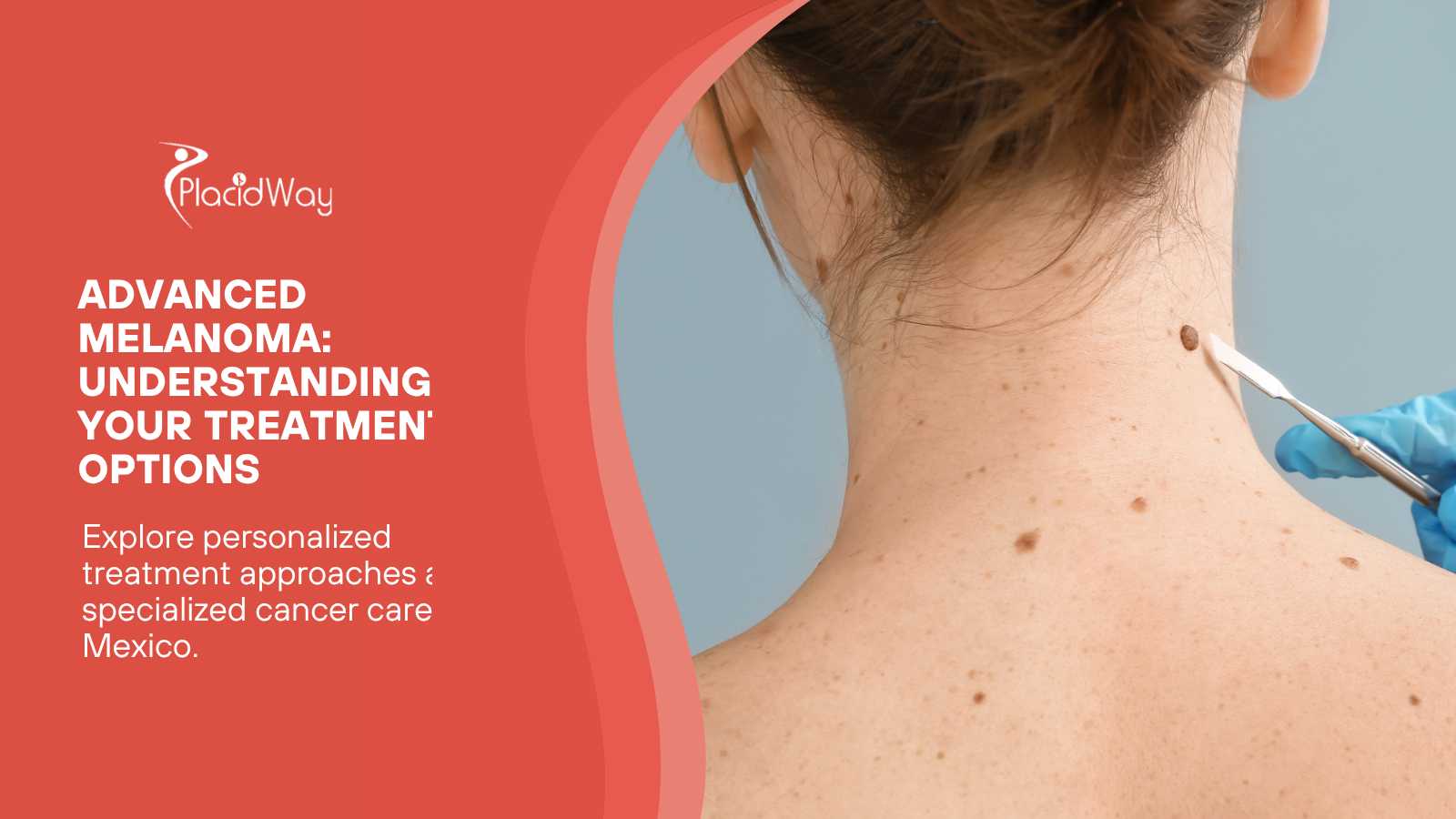 Melanoma That Has Spread Beyond the Skin: Advanced Treatment Options in Mexico
