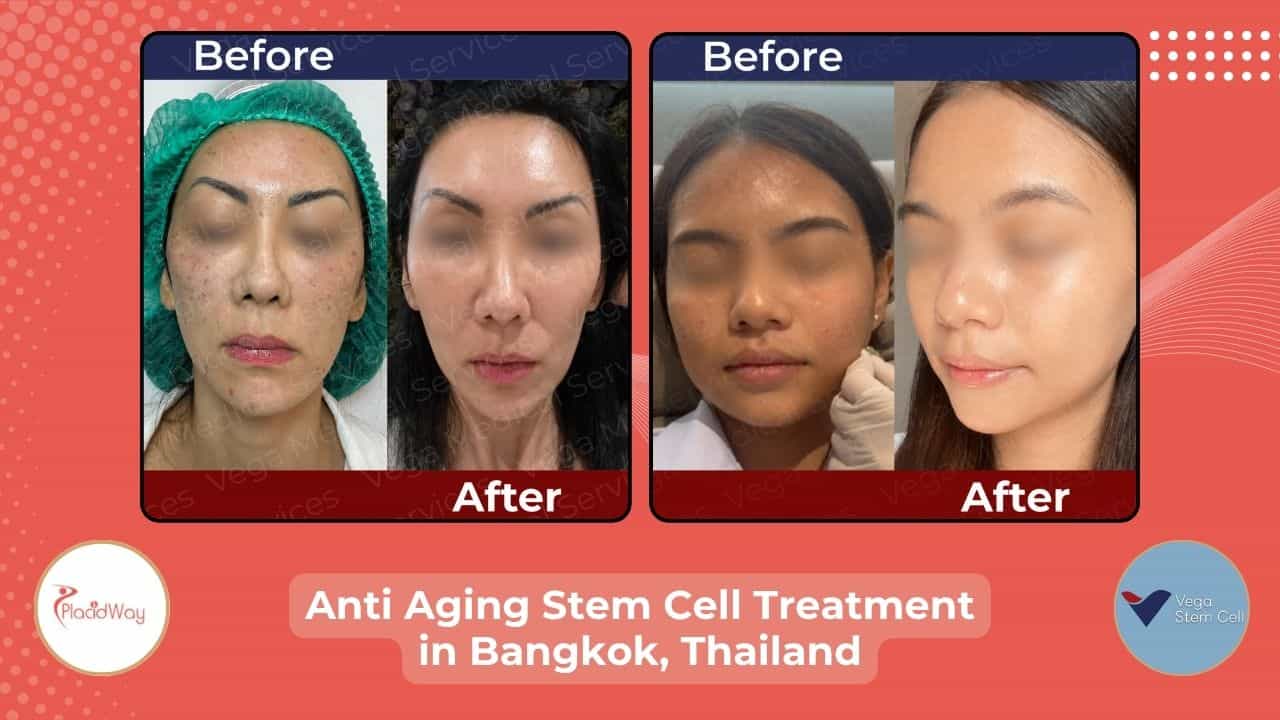 Anti Aging Stem Cell Treatment in Bangkok, Thailand Before After