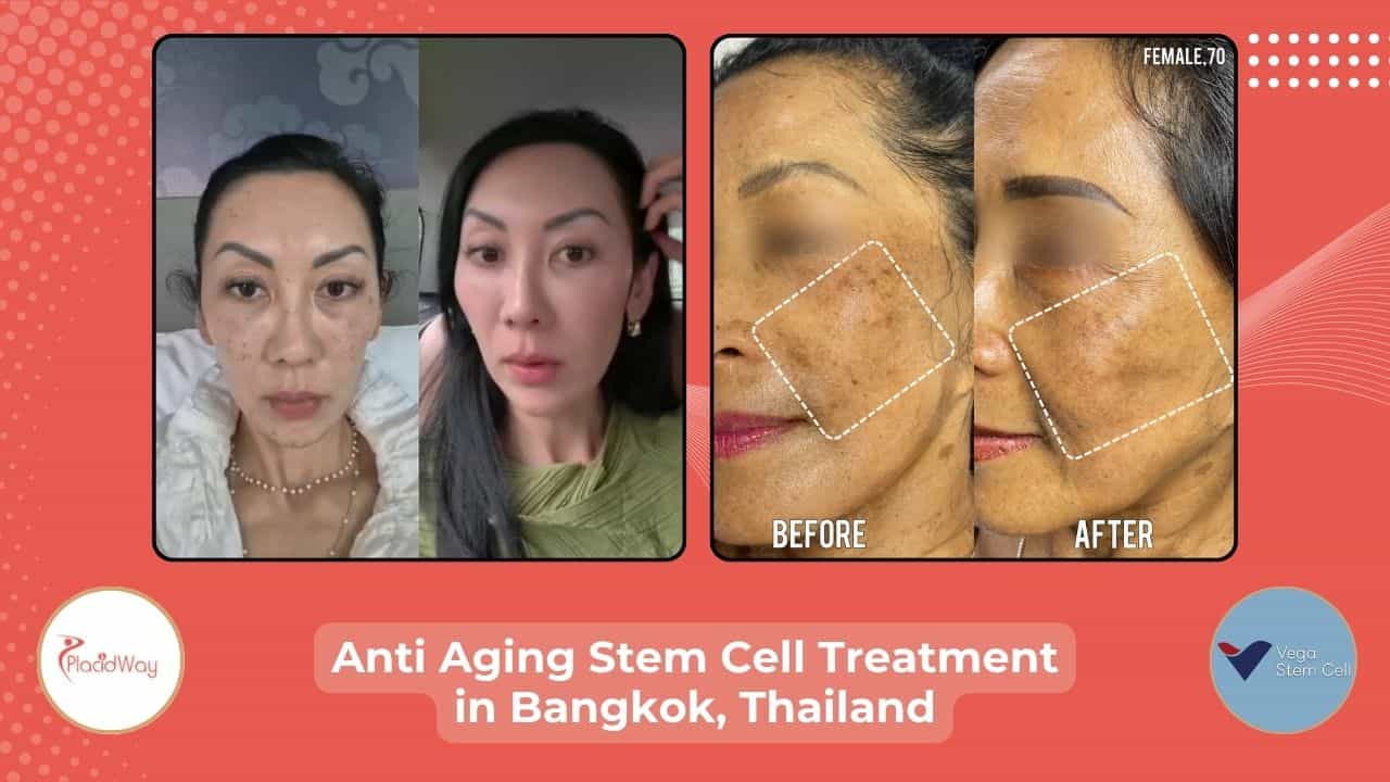 Anti Aging Stem Cell Treatment in Bangkok, Thailand Before After Image