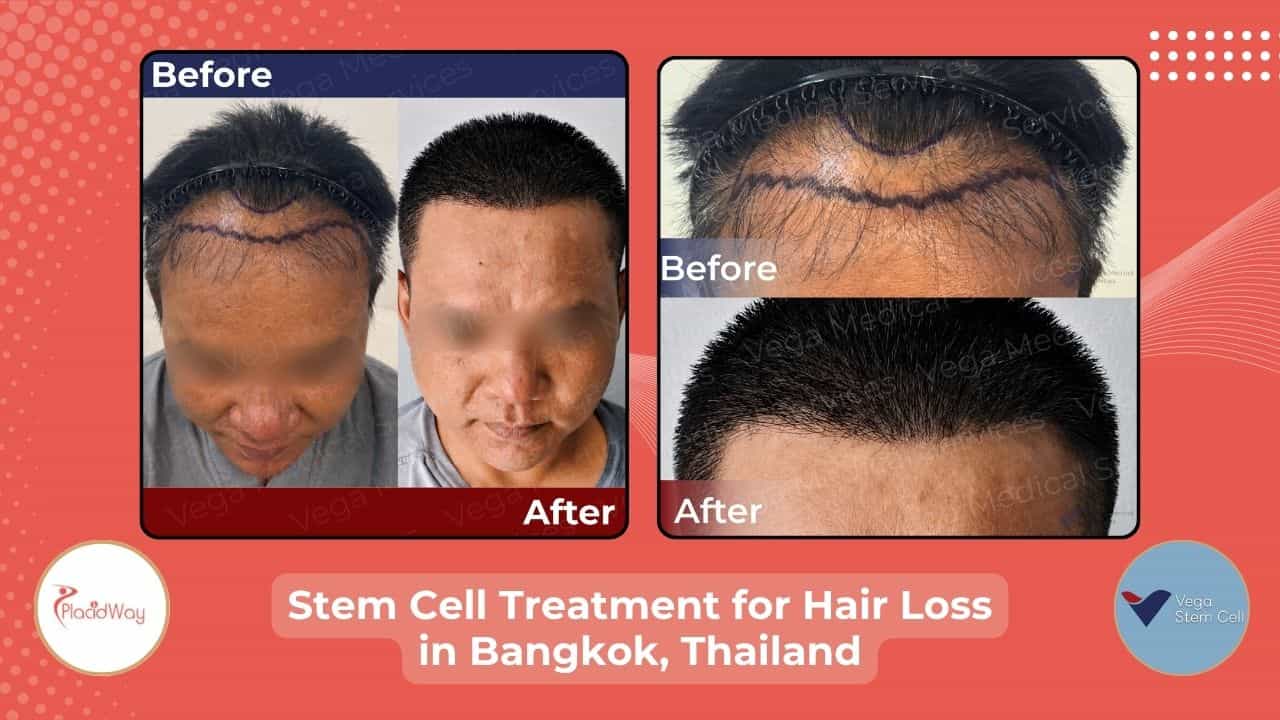Stem Cell Treatment for Hair in Bangkok, Thailand